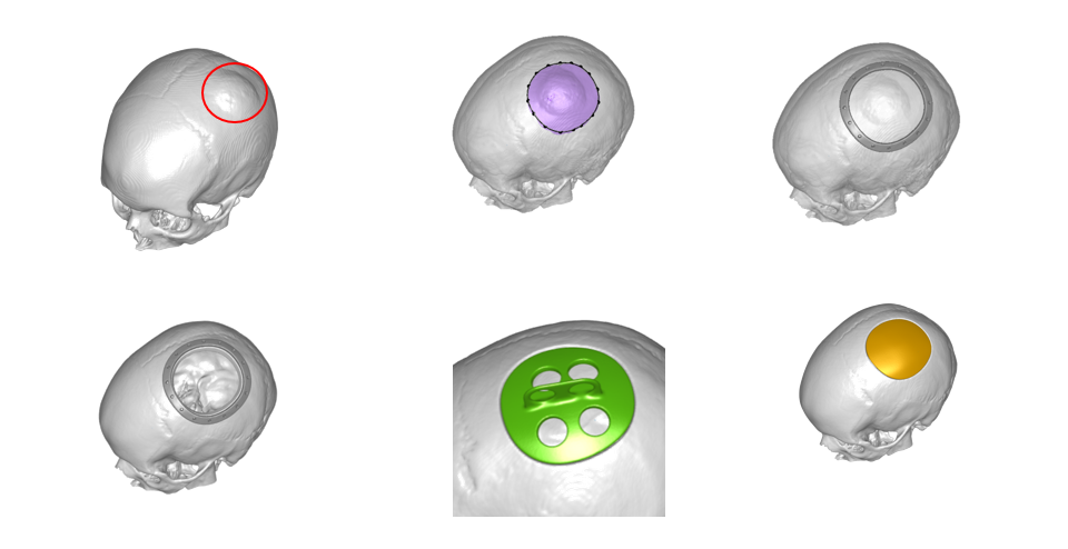 3D rendering of patient-specific cranial implants by CranioM3D
